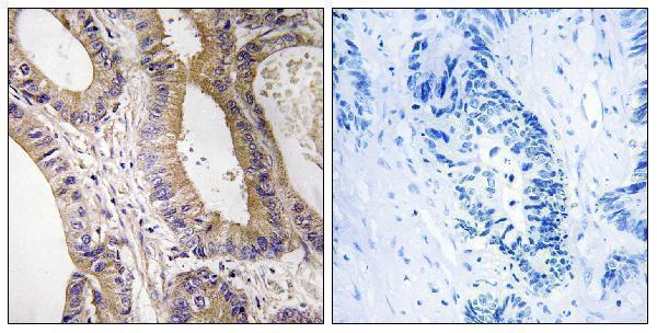 Immunohistochemistry analysis of paraffin-embedded human colon carcinoma tissue, using STK24 Antibody