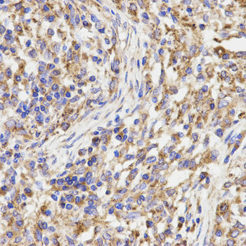 Immunohistochemistry (IHC) analysis of KLC1 polyclonal antibody in paraffin-embedded Human Lung Cancer tissue