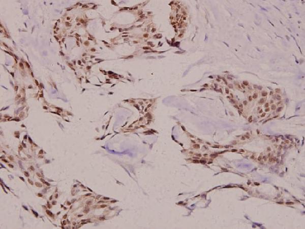 Immunohistochemistry (IHC) analyzes of TEBP (K107) pAb in paraffin-embedded human breast carcinoma tissue at 1:100