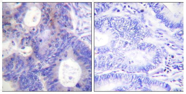 Immunohistochemistry analysis of paraffin-embedded human colon carcinoma, using TEBP (Phospho-Ser113) Antibody