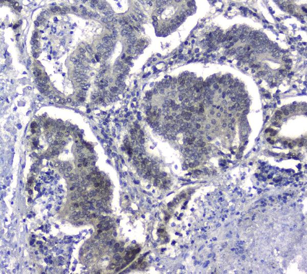 IHC analysis of Hsp105 using anti-Hsp105 antibody (A04168). Hsp105 was detected in paraffin-embedded section of human intestinal cancer tissues. Heat mediated antigen retrieval was performed in citrate buffer (pH6, epitope retrieval solution) for 20 mins. The tissue section was blocked with 10% goat serum. The tissue section was then incubated with 2μg/ml rabbit anti-Hsp105 Antibody (A04168) overnight at 4°C. Biotinylated goat anti-rabbit IgG was used as secondary antibody and incubated for 30 minutes at 37°C. The tissue section was developed using Strepavidin-Biotin-Complex (SABC)(Catalog # SA1022) with DAB as the chromogen.