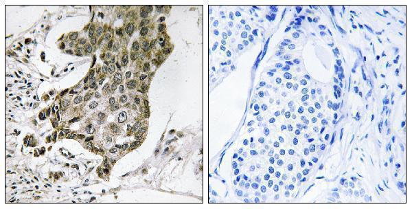 Immunohistochemistry analysis of paraffin-embedded human breast carcinoma tissue, using RABEP1 Antibody
