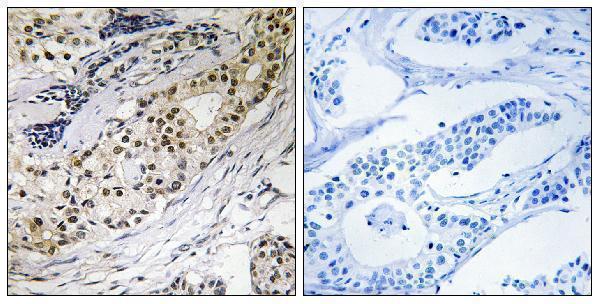Immunohistochemistry analysis of paraffin-embedded human colon carcinoma tissue, using LAMA3 Antibody