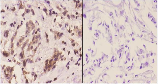 Immunohistochemistry (IHC) analyzes of 14-3-3 η (K81) pAb in paraffin-embedded human breast carcinoma tissue at 1:50