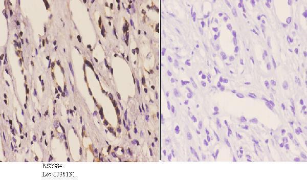 Immunohistochemistry (IHC) analyzes of 14-3-3 η (K81) pAb in paraffin-embedded human kidney carcinoma tissue at 1:50