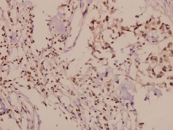 Immunohistochemistry (IHC) analyzes of PLC β3 (D1099) pAb in paraffin-embedded human breast carcinoma tissue at 1:50
