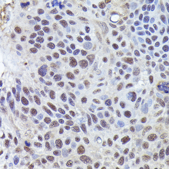 Immunohistochemistry of paraffin-embedded human esophageal cancer using CRCP Rabbit pAb  at dilution of 1:200 