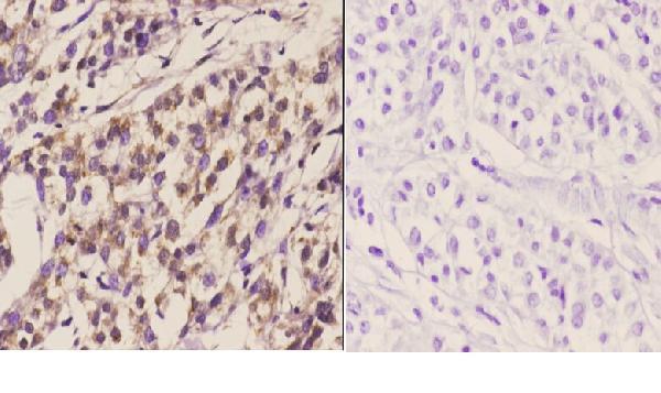 Immunohistochemistry (IHC) analyzes of TIEG2 (F6) pAb in paraffin-embedded human liver carcinoma tissue at 1:50