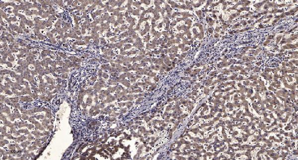 Immunohistochemical analysis of paraffin-embedded human liver cancer