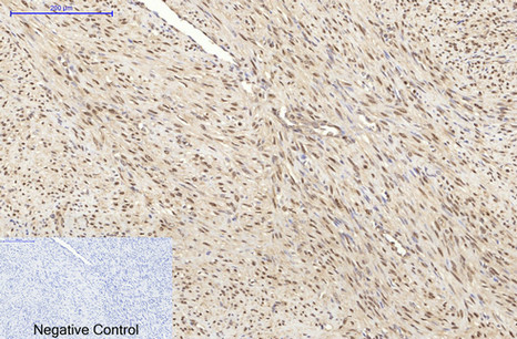 Immunohistochemical analysis of paraffin-embedded Human-uterus-cancer tissue