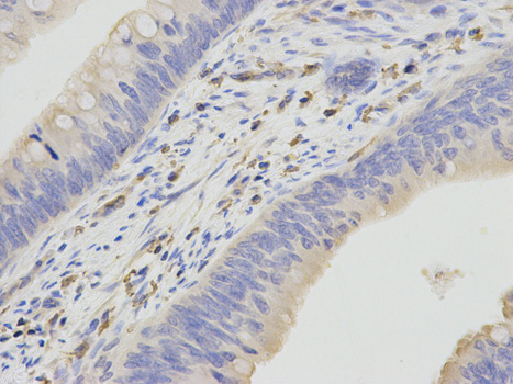 Immunohistochemistry of paraffin-embedded human liver cancer using HCLS1 antibody  at dilution of 1:100 