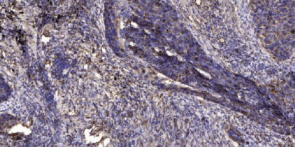 Immunohistochemical analysis of paraffin-embedded human Squamous cell carcinoma of lung