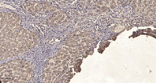 Immunohistochemical analysis of paraffin-embedded human liver cancer