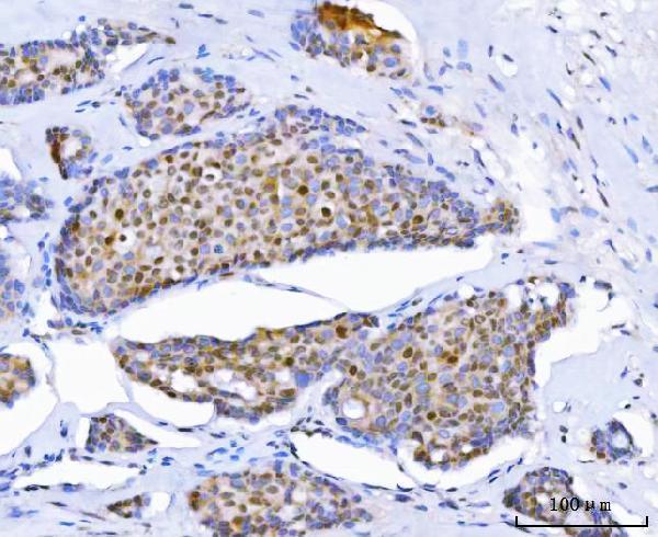  IHC analysis of Thymidylate Synthase/TYMS using anti-Thymidylate Synthase/TYMS antibody (A04320-4)