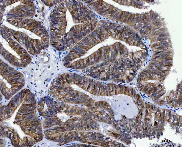  IHC analysis of Thymidylate Synthase/TYMS using anti-Thymidylate Synthase/TYMS antibody (A04320-4)