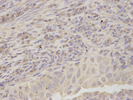 Immunohistochemistry (IHC) analysis of RPLP0 polyclonal antibody in paraffin-embedded Human Endometrial Cancer tissue