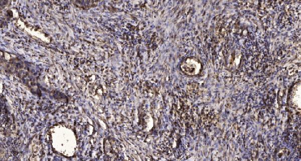 Immunohistochemical analysis of paraffin-embedded human Squamous cell carcinoma of lung