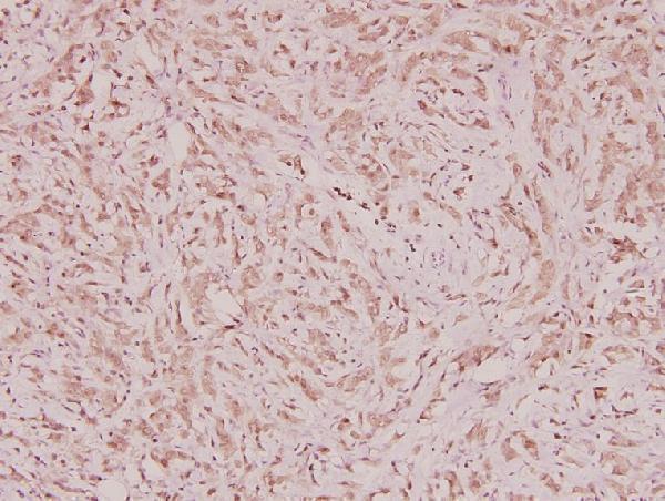 Immunohistochemistry (IHC) analyzes of ARA70 (L379) pAb in paraffin-embedded human breast carcinoma tissue at 1:100