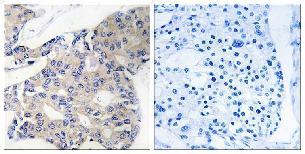 Immunohistochemistry analysis of paraffin-embedded human breast carcinoma, using NCOA4 Antibody