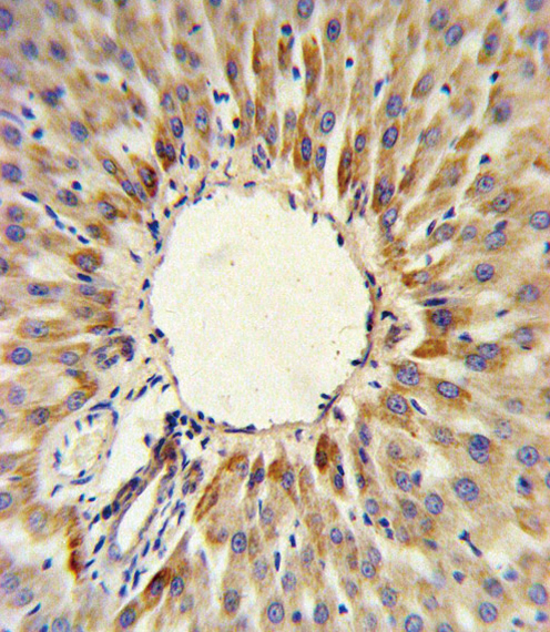 HMGCS2 Antibody (C-term) IHC analysis in formalin fixed and paraffin embedded human hepatocarcinoma followed by peroxidase conjugation of the secondary antibody and DAB staining