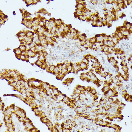 Immunohistochemistry of paraffin-embedded human thyroid cancer using HMGCS2 antibody  at dilution of 1:100 