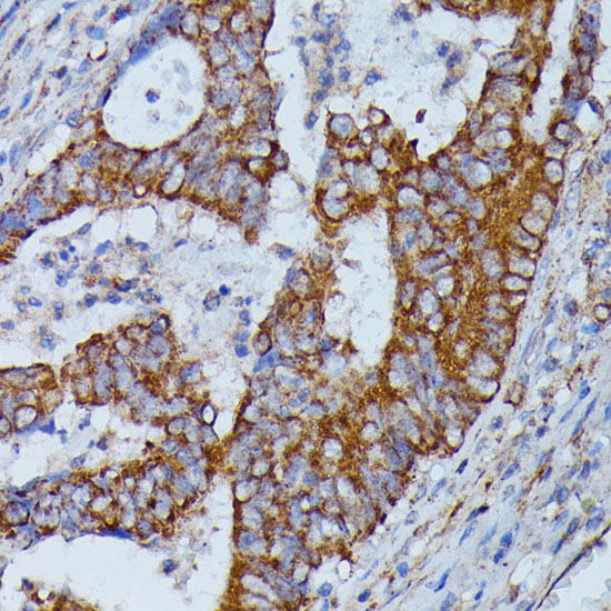 Immunohistochemistry of paraffin-embedded human colon carcinoma using HMGCS2 antibody  at dilution of 1:100 