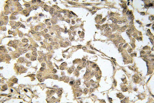Immunohistochemistry (IHC) analyzes of p-eIF2α (S51) pAb in paraffin-embedded human breast carcinoma tissue