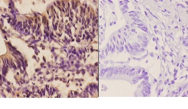 Immunohistochemistry (IHC) analyzes of Oct-2 (H3) pAb in paraffin-embedded human colon carcinoma tissue at 1:50