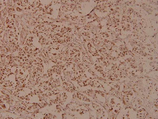 Immunohistochemistry (IHC) analyzes of RRS1 (R286) pAb in paraffin-embedded human breast carcinoma tissue at 1:100