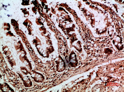Immunohistochemical analysis of paraffin-embedded human-colon, antibody was diluted at 1:200