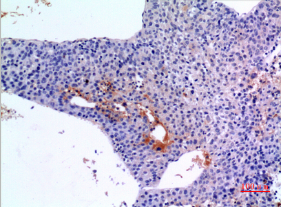 Immunohistochemical analysis of paraffin-embedded human-liver-cancer, antibody was diluted at 1:100