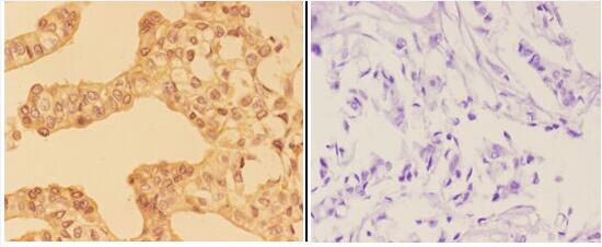 Immunohistochemistry (IHC) analyzes of AMPKγ1/2/3 (K78) pAb in paraffin-embedded human breast carcinoma tissue at 1:50,showing cytoplasm and nuclear staining