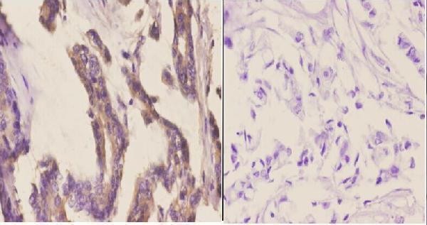 Immunohistochemistry (IHC) analyzes of CYP2A13 (N338) pAb in paraffin-embedded human breast carcinoma tissue at 1:50