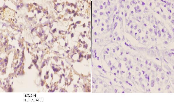 Immunohistochemistry (IHC) analyzes of CYP2A13 (N338) pAb in paraffin-embedded human liver carcinoma tissue at 1:50
