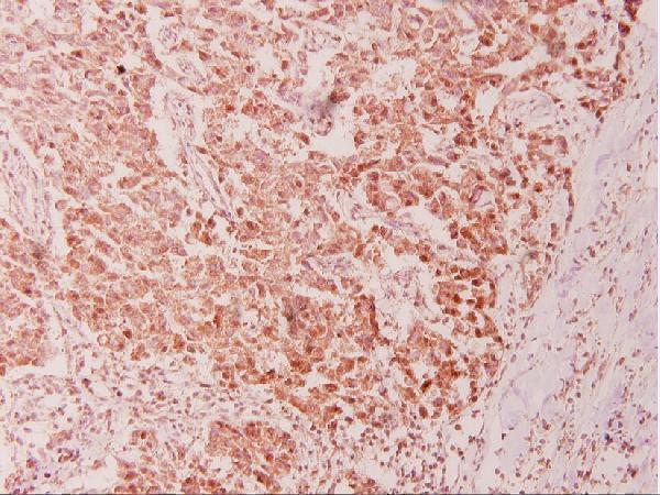Immunohistochemistry (IHC) analyzes of CSE1L (E2) pAb in paraffin-embedded human breast carcinoma tissue at 1:100