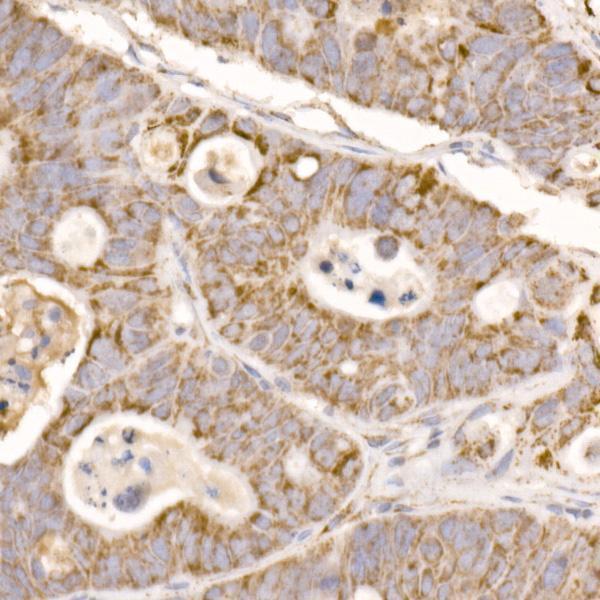 Immunohistochemistry of paraffin-embedded human colon carcinoma using GLUD2 Rabbit pAb  at dilution of 1:50 