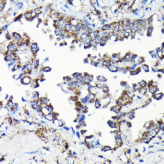 Immunohistochemistry of paraffin-embedded human lung cancer using USP5 Rabbit pAb  at dilution of 1:100 