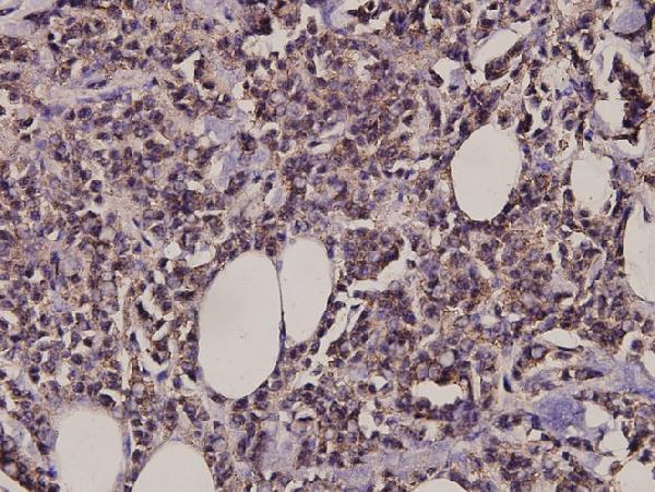 Immunohistochemistry (IHC) analyzes of MARK1/2/3/4 (N211) pAb in paraffin-embedded human breast carcinoma tissue at 1:100