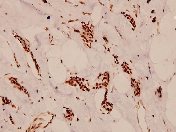 Immunohistochemistry (IHC) analyzes of Cdc16 (K556) pAb in paraffin-embedded human breast carcinoma tissue at 1:100