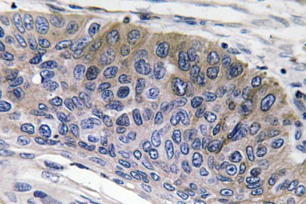 Immunohistochemistry analysis of IgG1 antibody in paraffin-embedded human lung carcinoma tissue
