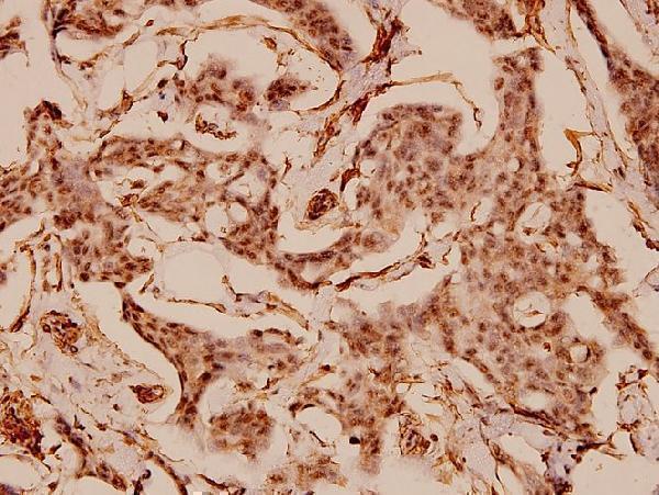 Immunohistochemistry (IHC) analyzes of Caldesmon (S783) pAb in paraffin-embedded human breast carcinoma tissue at 1:100