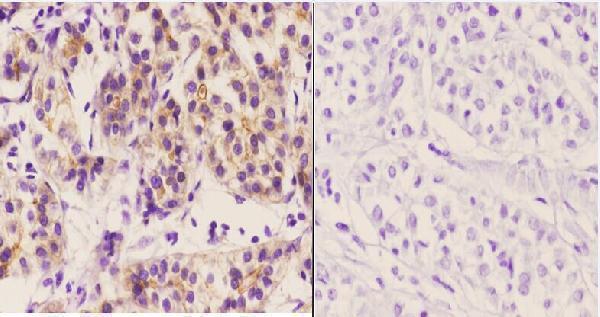 Immunohistochemistry (IHC) analyzes of SMIF (S133) pAb in paraffin-embedded human liver carcinoma tissue at 1:50