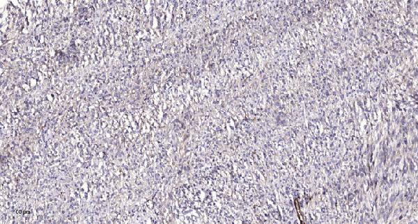 Immunohistochemical analysis of paraffin-embedded human Colon cancer