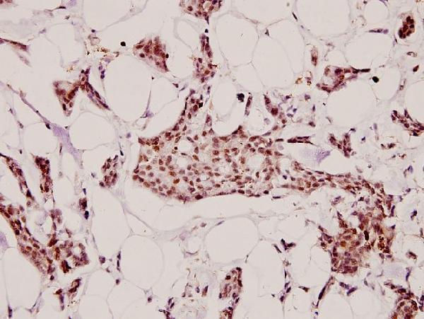 Immunohistochemistry (IHC) analyzes of HC-II (D68) pAb in paraffin-embedded human breast carcinoma tissue at 1:100