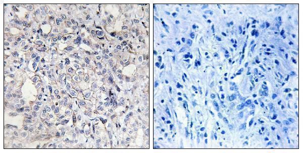 Immunohistochemistry analysis of paraffin-embedded human liver carcinoma tissue, using Heparin Cofactor II Antibody