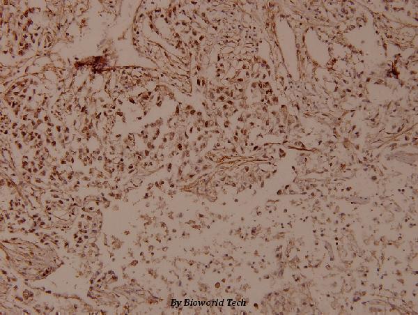 Immunohistochemistry (IHC) analyzes of FMIP (E602) pAb in paraffin-embedded human breast carcinoma tissue at 1:100