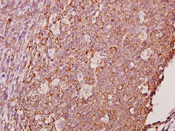 Immunohistochemistry (IHC) analyzes of Ephrin-A1 (K98) pAb in paraffin-embedded human tonsil carcinoma tissue at 1:50