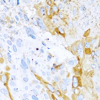 Immunohistochemistry of paraffin-embedded mouse esophageal cancer using SPINT1 antibody at dilution of 1:100 (40x lens)