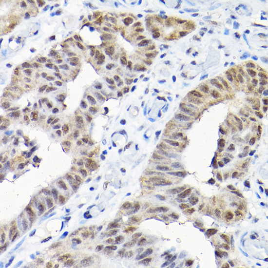 Immunohistochemistry of paraffin-embedded human colon carcinoma using SNRPF Rabbit pAb  at dilution of 1:200 