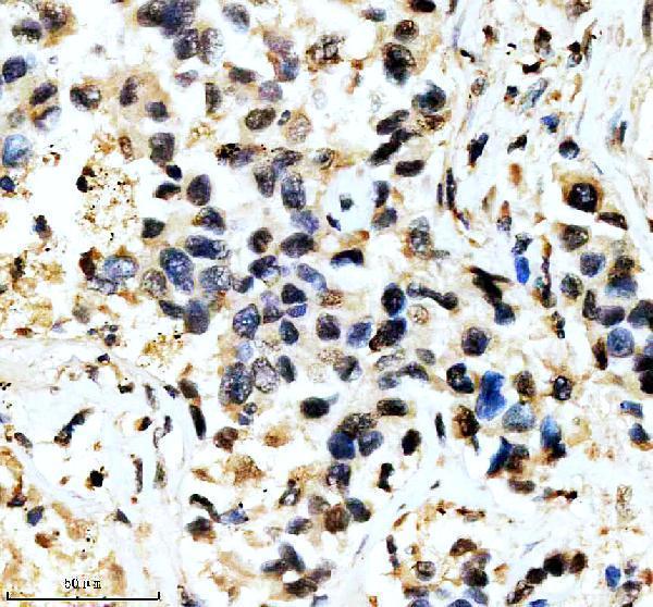 IHC analysis of RPA3 using anti-RPA3 antibody (A04696-2)
